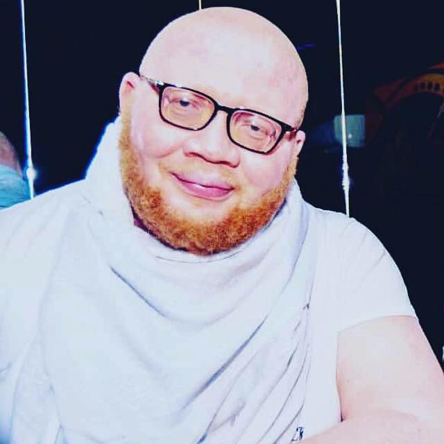 Yan Mambo, albinos et fier de l’être ! 4
