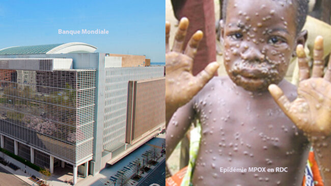 Banque Mondiale MPOX RDC